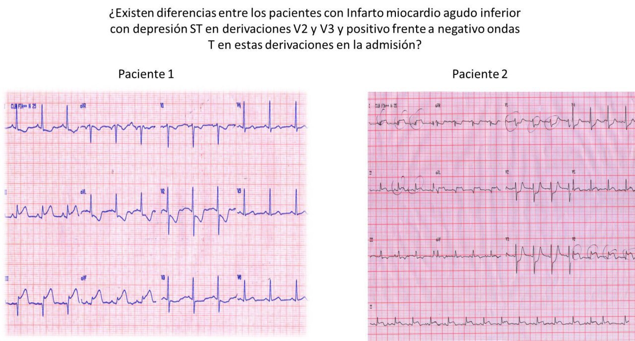ECGs de dos pacientes con IAM inferior y diferencias de polaridad de T en cara anterior