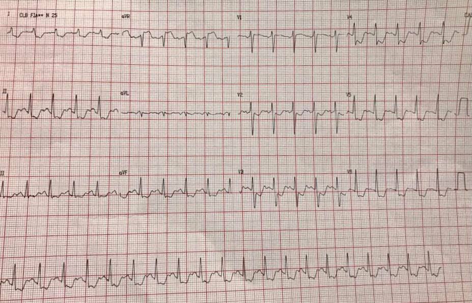 Paciente que ingresa con ángor que se corresponde a un espasmo del TCI que cede con vasodilatadores intracoronarios