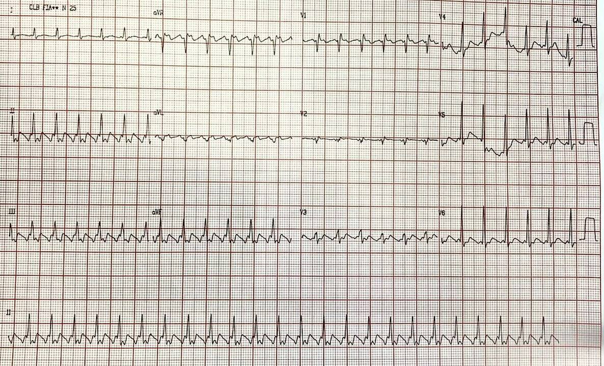 Varón de 70 años que consulta por astenia, mareos y palpitaciones por presencia de AA 2:1
