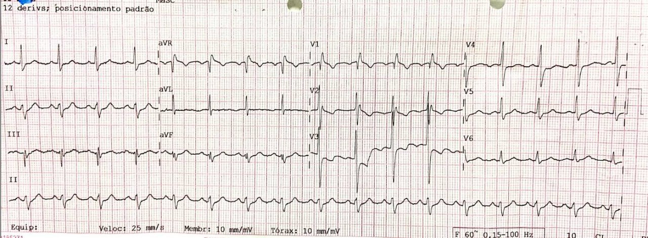 Paciente masculino de 63 años con antecedentes familiares de IAM, que presenta episodio de ángor de reposo, cuya CCG se demora y que presenta oclusión de la DA